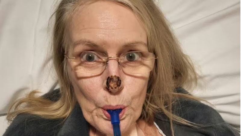 İngiltere’de et yiyen bakteri, hasta kadının burnunu aşındırdı