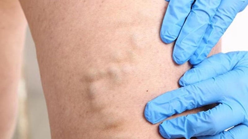 Damar sertliğine hangi bölüm bakar? Damar sertliği için hangi doktora gidilir?