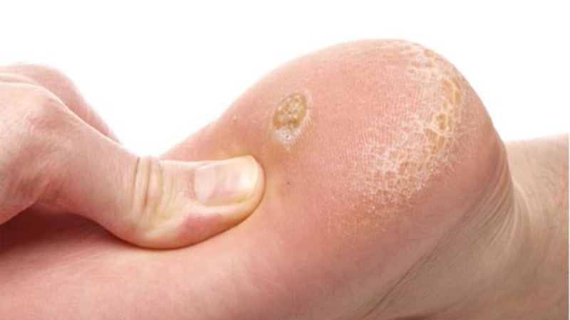 Nasır için hangi doktora gidilir? Nasıra hangi bölüm bakar?