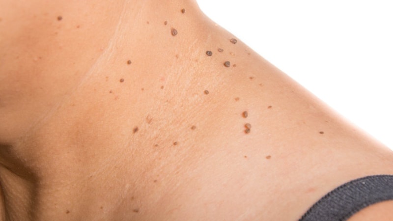 Soğan ve sabunu karıştırın, siğillere temelli veda edin...