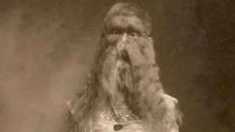 Yüzünün tamamı kıllarla kaplı! Gören inanamıyor, sadece gözeleri gözüküyor...