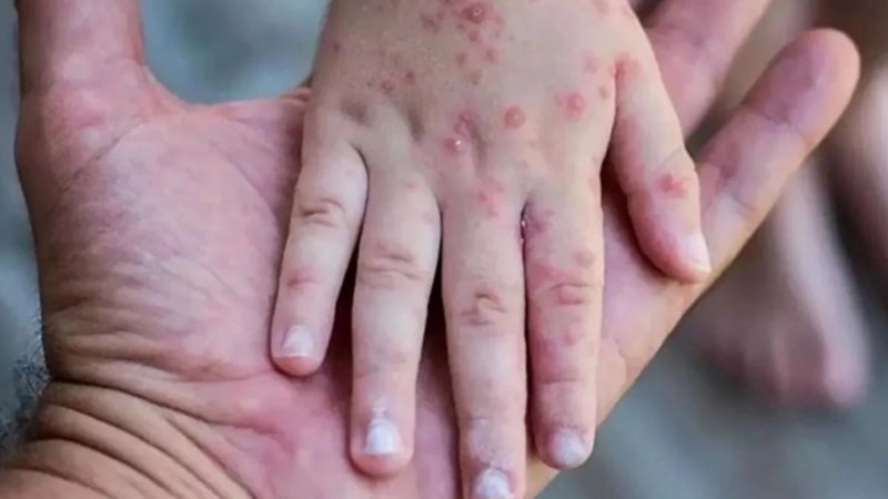 Dünya alarmda! İşte maymun çiçeği virüsünden korunmanın yolları