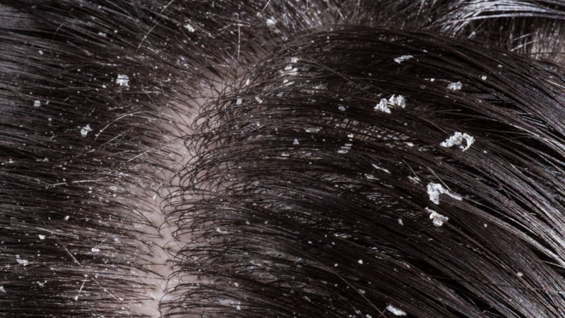 İbn-i Sina yıllar önce kökten çözmüş! Bu yöntemle kepeğin 