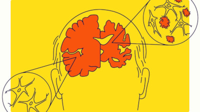 Yapay zeka, sesinizden Alzheimer  riskini tahmin ediyor