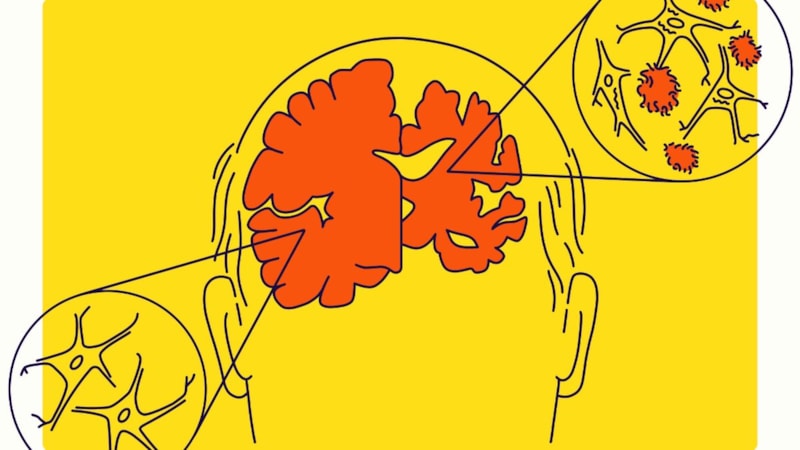 Yapay zeka, sesinizden Alzheimer  riskini tahmin ediyor