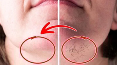 Yüzdeki tüyleri yok etmenin yolu; Tek bir damlası kökleri kurutuyor