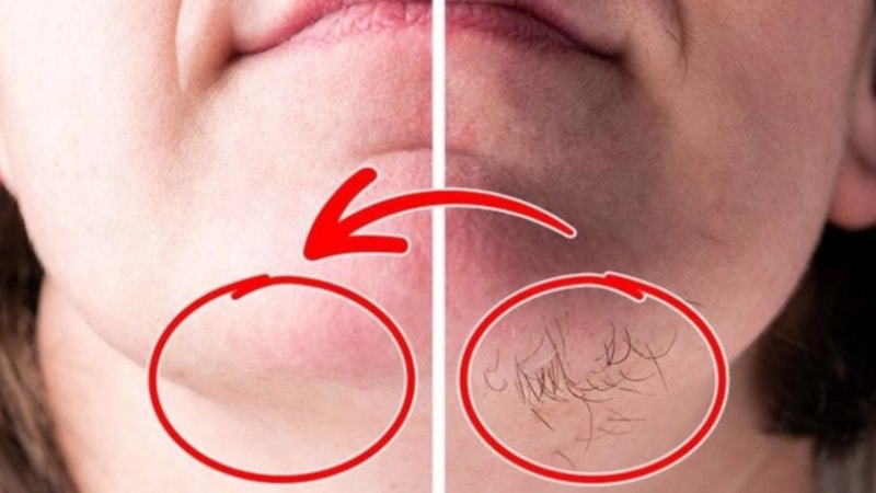 Yüzdeki tüyleri yok etmenin yolu; Tek bir damlası kökleri kurutuyor