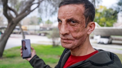 Türkiye'de ilk yüz nakli yapılan Uğur Acar'dan duygusal görüşme