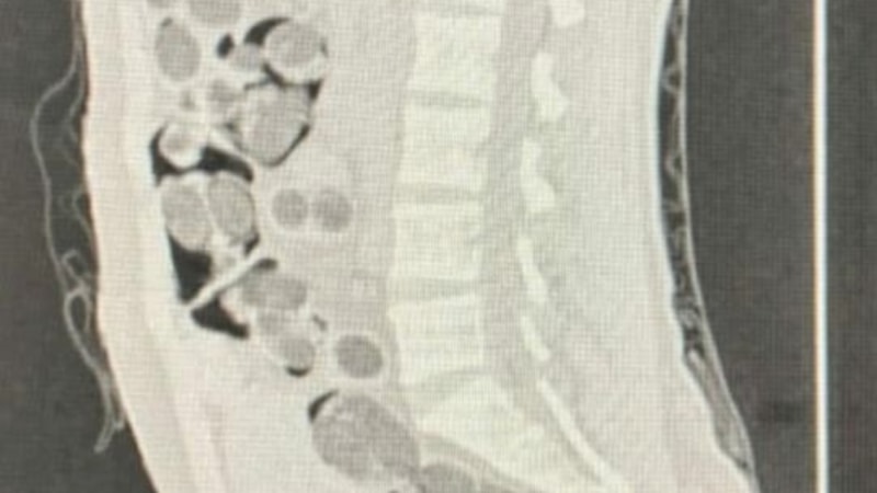 Denizli'de yabancı uyruklu yolcunun midesinden 219 paket uyuşturucu çıktı