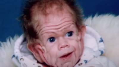 Bilim dünyasını hayrete düşürmüştü: Yaşlı bir insanın cildiyle doğan bebeğin yıllar sonraki değişimi