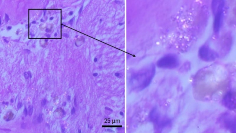 Korkutan araştırma: Mikroplastikler artık insan beyninde birikiyor
