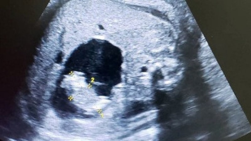 Hindistan’da doğmamış bebeğin karnında iki fetüs bulundu