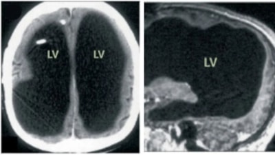 Fransa'da bacak ağrısı yüzünden hastaneye gitti: Yıllarca yarım beyinle yaşadığını öğrendi