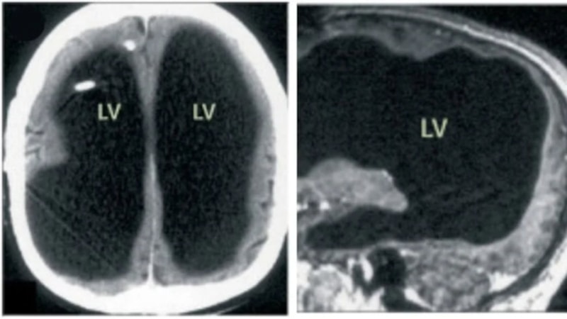 Fransa'da bacak ağrısı yüzünden hastaneye gitti: Yıllarca yarım beyinle yaşadığını öğrendi