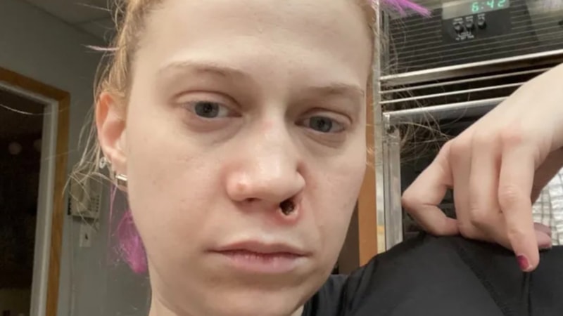 ABD'de uyuşturucu bağımlısı kadının burnu düştü