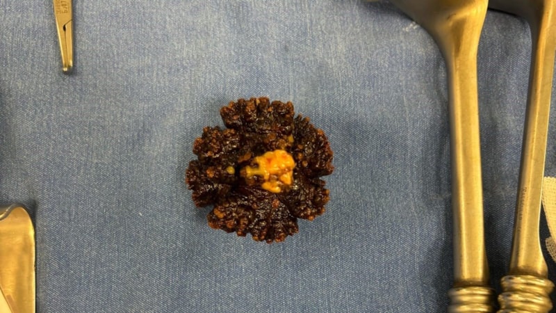 Afyonkarahisar'da hastanın mesanesinden 7 cm boyutunda taş çıktı