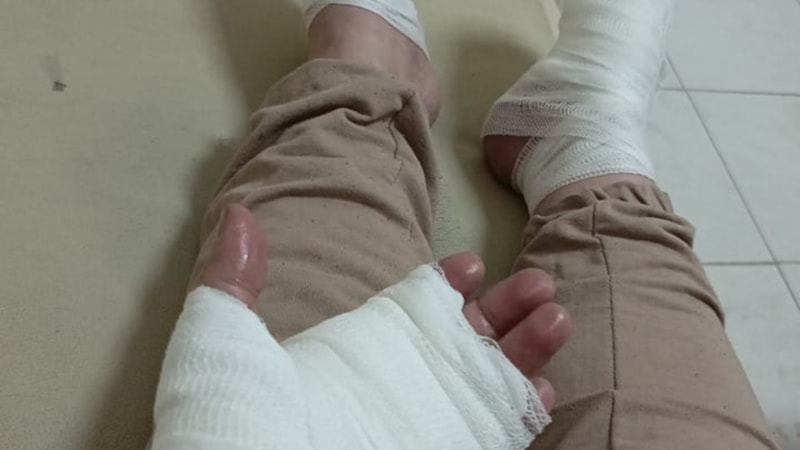 Hakkari'de lavabo açıcı patladı, iki kardeş yandı