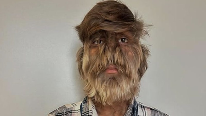 Hindistan'da dünyanın en kıllı yüzüne sahip genç Guinness Rekorlar Kitabı'na girdi