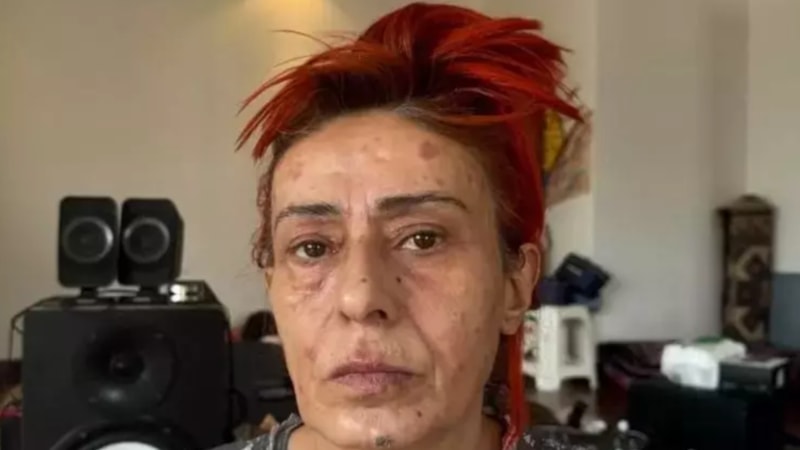 Saç boyası yüzünden yüzünde yanıklar oluşmuştu! Yıldız Tilbe son durumunu açıkladı