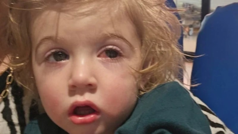 İngiltere'de 2 yaşındaki çocuk 'öpücük' yüzünden kör oldu