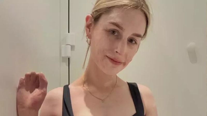 Yeni Zelanda'da tatil için gittiği adada hem vücudu yandı hem de ailesini kaybetti