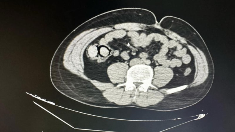 Bingöl'de midelerinden 10 parça halinde uyuşturucu çıktı