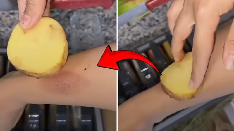 Yanığa bir dilim koyun, mucizeyi seyredin! Doktorlar bile şaşkın