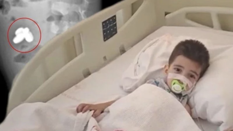 İstanbul'da pil ve mıknatıs yutan çocuğun bağırsakları yandı