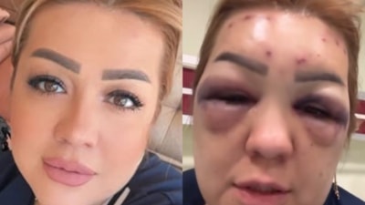 Kahramanmaraş'ta botoks yaptıran kadının yüzü tanınmayacak hale geldi