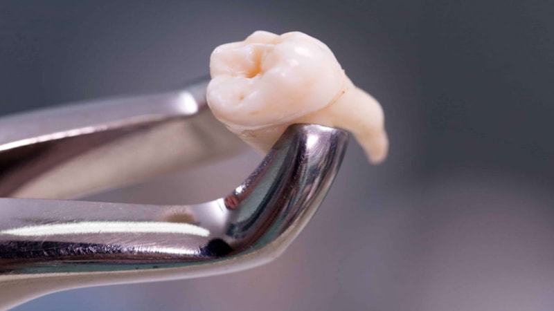 20'lik dişleri olan yaşadı: Servete dönüşüyor...