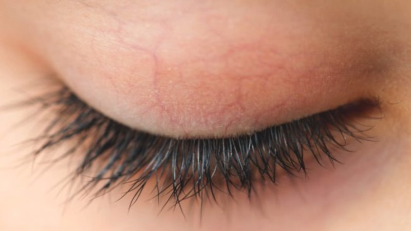 Kirpikleriniz yastıktaysa eyvah: O hastalığın ilk evresi...