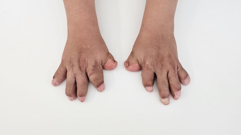 Doktorların ismini yeni duyduğu rahatsızlıkla doğan Umut'un 10 parmağı ameliyatla açıldı