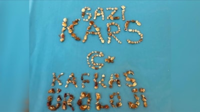 Kars'ta hastanın iki böbreğinden 300'ün üzerinde taş çıktı