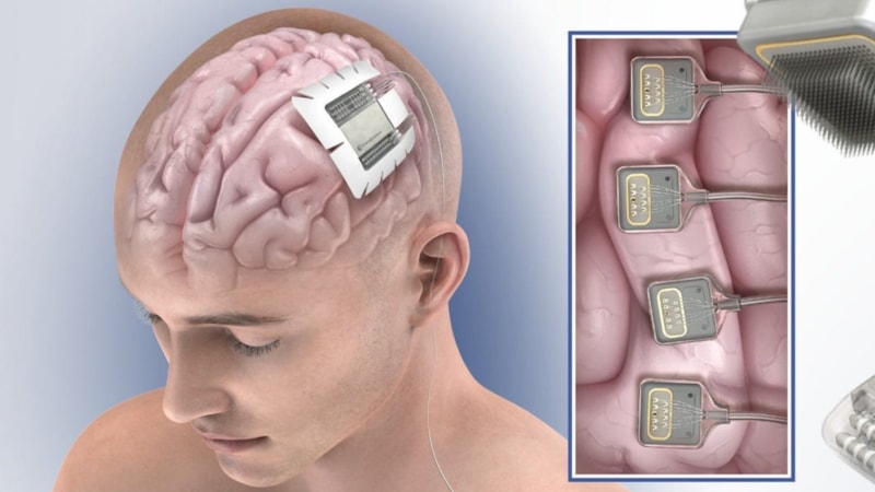 Neuralink rakibi şirket, bu yıl ilk beyin implantını üretecek