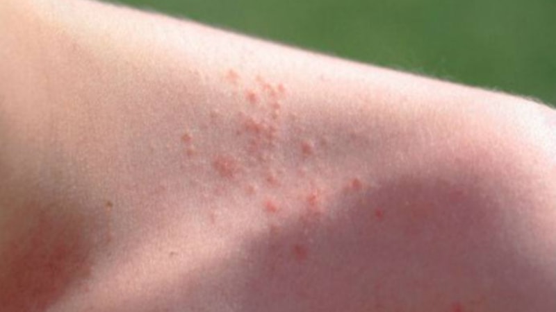 Teninizi onunla silin, isilikleri geçirin...