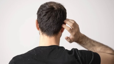 Saç dökülmesi nasıl geçer? Saç dökülmesi en hızlı nasıl durdurulur?