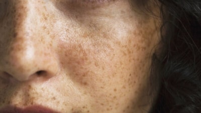 Güneş lekelerine İbn-i Sina yöntemi: Silgi gibi siliyor...