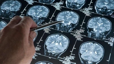 Alzheimer riskini artıran genetik varyant bulundu