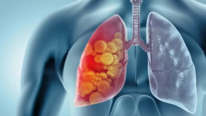 ABD'de 17 yaşındaki genç kızda patlamış mısır hastalığı görüldü