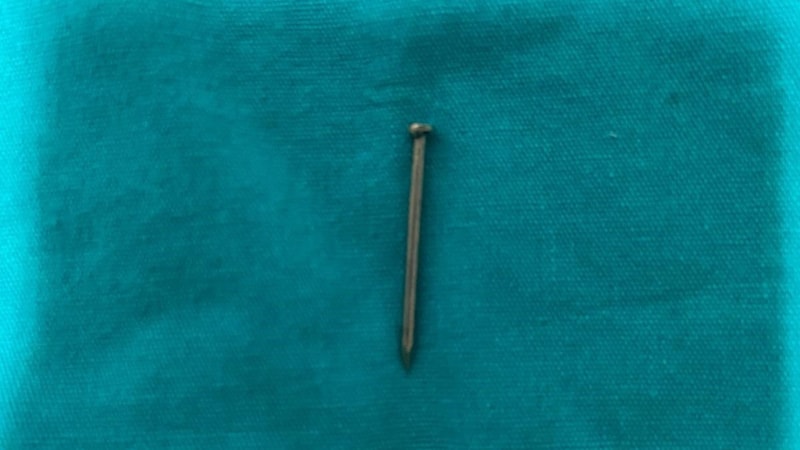Isparta'da minik çocuğun midesinden 4 santimetrelik çivi çıkarıldı