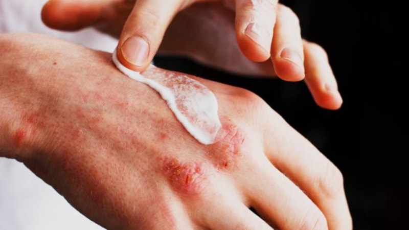 Egzamayı en hızlı ne geçirir? İşte etkili çözümler