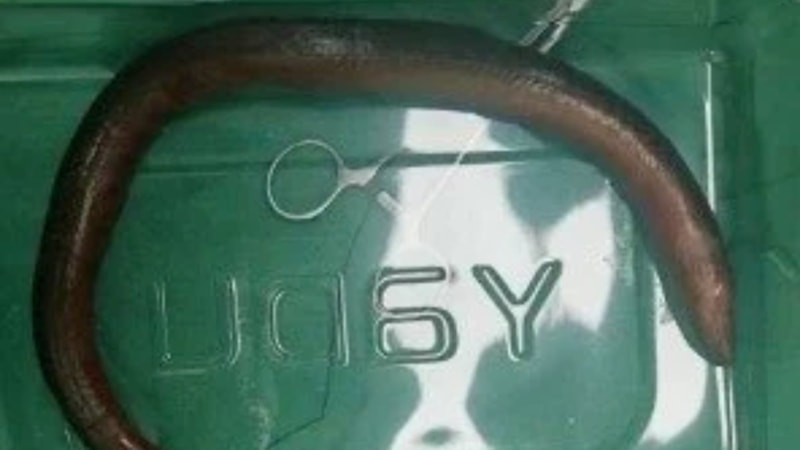 Çin'de hasta adamın karnından canlı yılan balığı çıktı