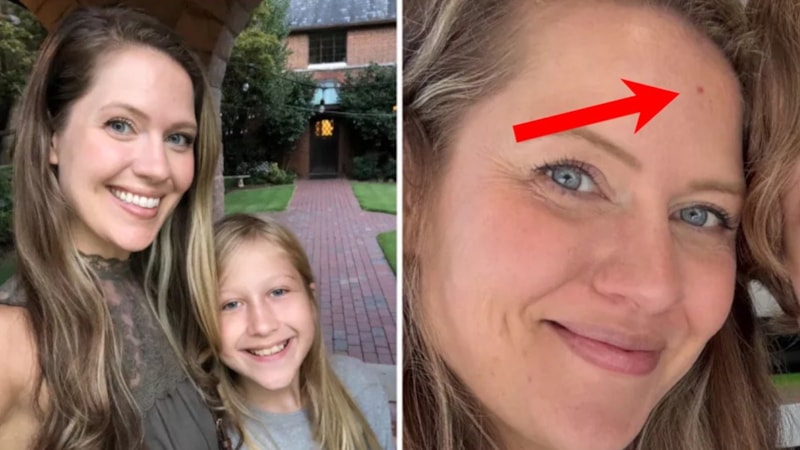 Sivilce sandı, kanser çıktı! Bu leke cilt kanseri belirtisiymiş