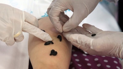 Sülük tedavisi caiz midir? Diyanet yanıtladı: Sülükle tedavinin hükmü...