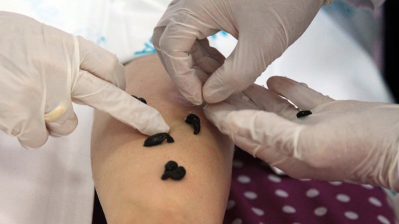 Sülük tedavisi caiz midir? Diyanet yanıtladı: Sülükle tedavinin hükmü...