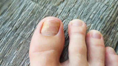 Tırnak mantarına doğal çözüm: 2 malzeme yetiyor, mantardan eser kalmıyor