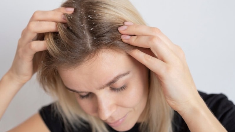 Saçta egzama neden olur? Saç egzamasına ne iyi gelir?