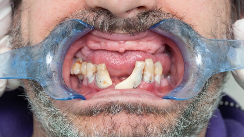 Kalp rahatsızlıklarının ardındaki sıradışı suçlu: Diş fırçalamamak