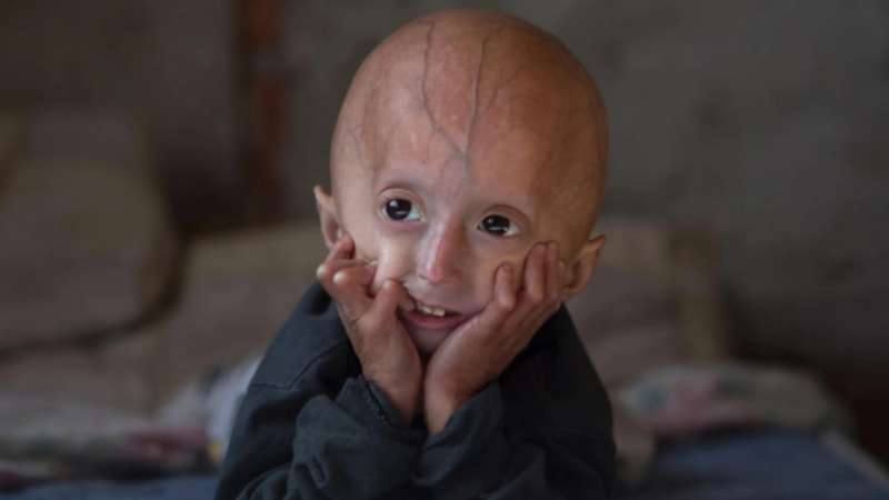 Çocuklarda hızla yaşlanmaya, ömür kısalmasına neden oluyor: Progeria hastalığı