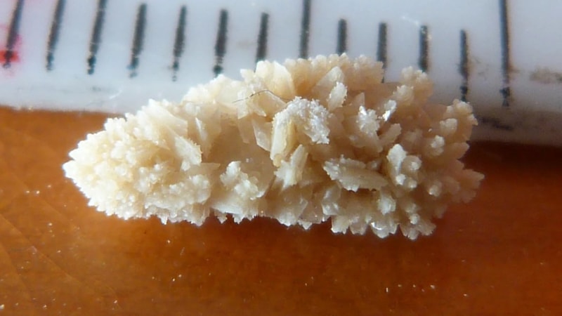 Böbrek taşlarının yeni düşmanı: Manyetik eritme robotu